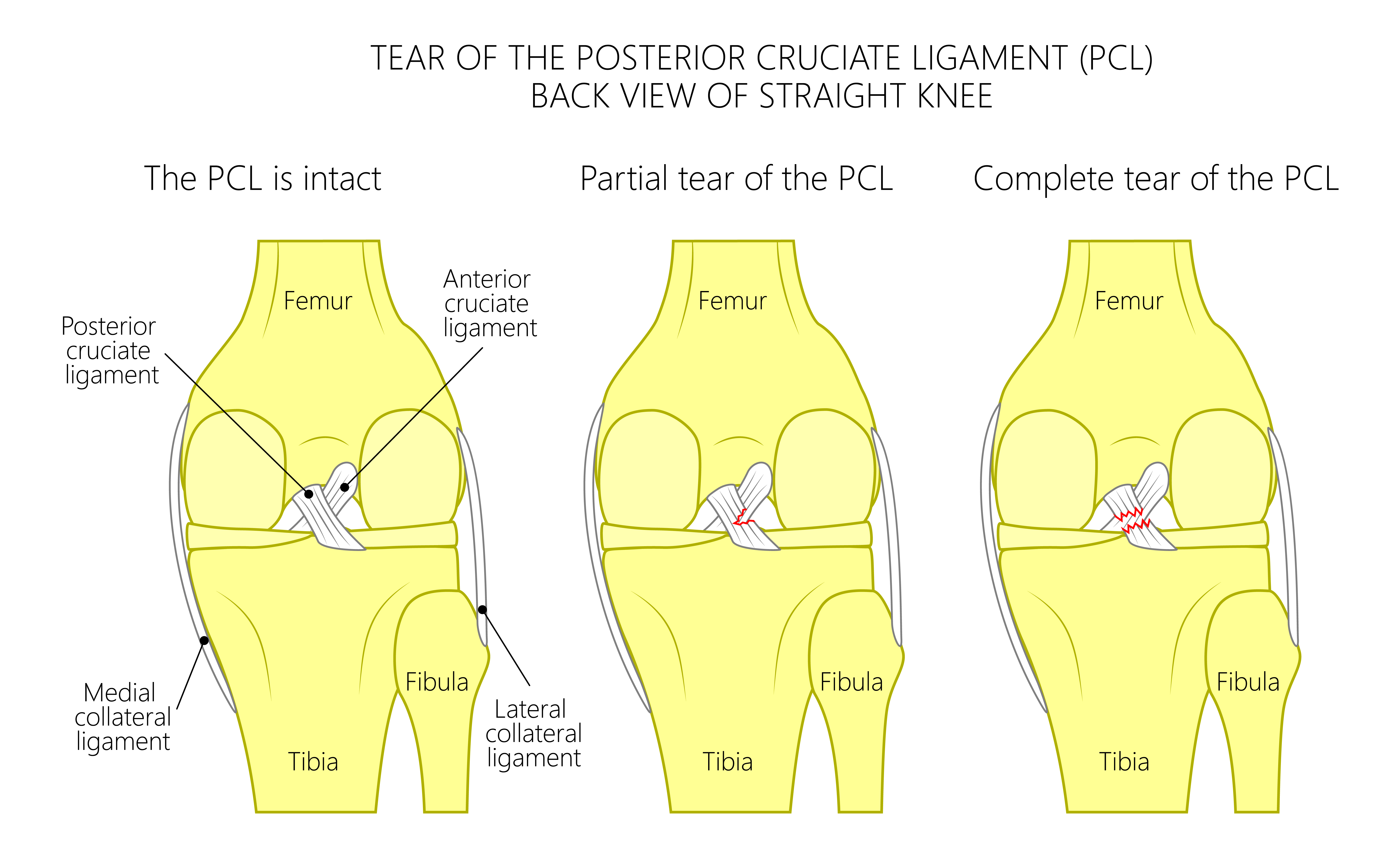 How can you tell the difference between a PCL and ACL tear?