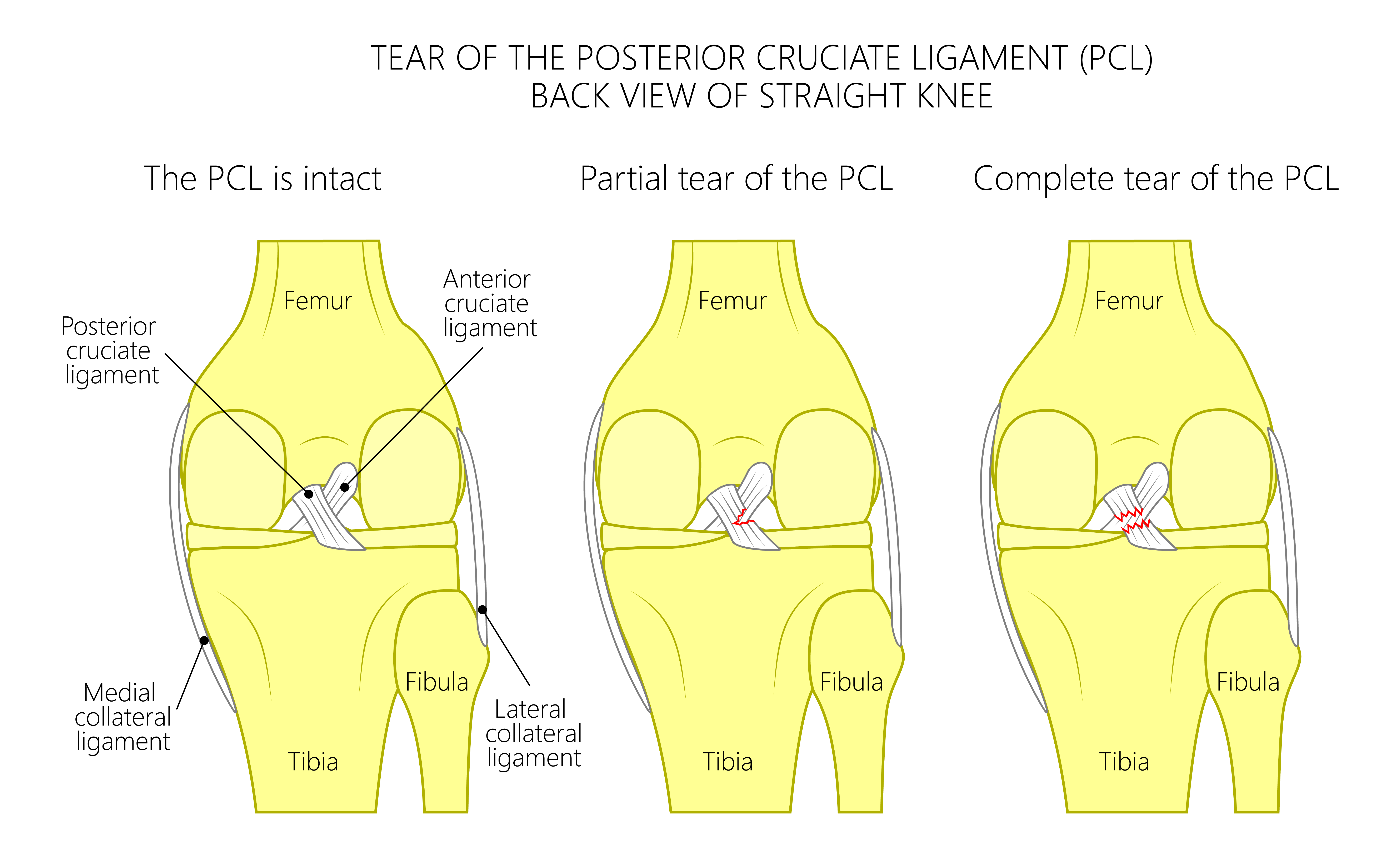 What Is The Difference Between An ACL Sprain And Tear Athletico